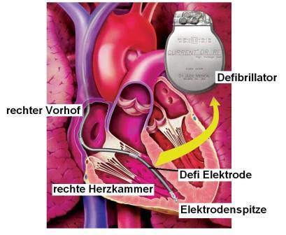 Schematische Darstellung: Defibrillator