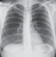 Röntgen der Lungen p.a.