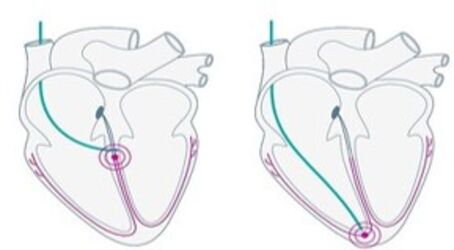 LBB Stimulation