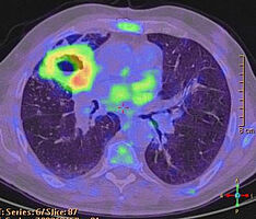 PET/CT der Lunge mit Karzinom
