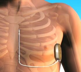 Schematische Darstellung der Sondenposition bei subkutan implantiertem Defibrillator