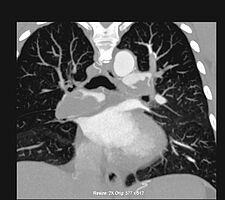 CT der Lunge mit großem Thrombus