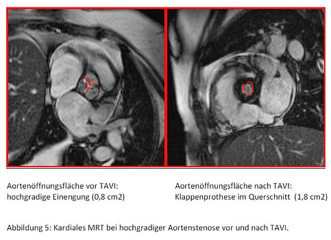Aortenklappenöffnung vor und nach TAVI