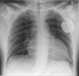 Röntgen-Thorax mit implantiertem 1-Kammer-Defibrillator System