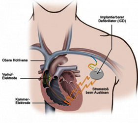 Schematische Darstellung der Sondenposition im Herz und Ausbreitung der Schockernergie bei Defibrillatortherapie